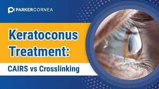 CAIRS vs Crosslinking - Keratoconus Treatment