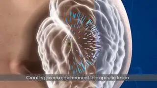 Focused Ultrasound Animation