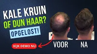 Dun Haar Mannen of Vrouwen - Oplossing Demo - Toupet Alternatief