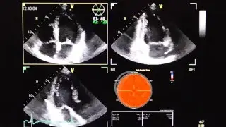 3D speckle tracking Echokardiographie (3 D speckle tracking imaging STI )