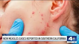 New measles cases reported in Southern California
