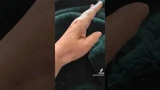 Limitations of 18 weeks post CMC joint fusion