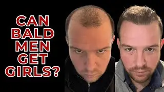 Can Bald Men Get Girls? Do Looks Matter?