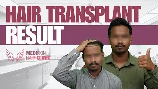 Hair Transplant Before & After Results | Real Patient Transformation | Medi Skin Hair Clinic