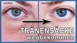 Tr&auml;nens&auml;cke und Augenringe wegbekommen mit Backpulver | dieses Hausmittel wirkt