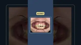 🦷&nbsp;Avant / Apr&egrave;s 🦷 C&rsquo;est toujours aussi fascinant de se rendre compte du changement !