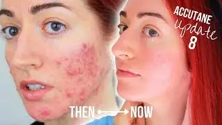 My Accutane Update (8 Months!) With Before & After | Jess Bunty