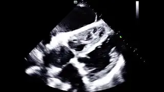 Cardiogenic shock ultrasound. Patient with syncope. 09/2021.