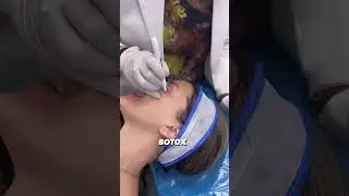 Botox Treatment For Face |  Botox Injection | Dr. Muskan Tyagi | Dermalyn Aesthetics |