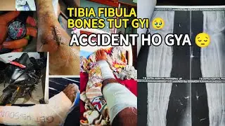 Accident ho gya 🥹ll tibia fibula bone Tut gyi 😔ll ab phle jaisa kuch nhi rha ll #accident 