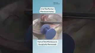 💥 Partial Meniscectomy!