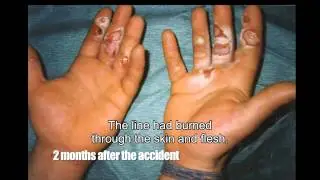 Fireman got badly burned