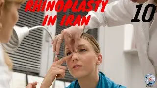 Nose Job in Iran l Top 10 Things to Know About Rhinoplasty in Iran