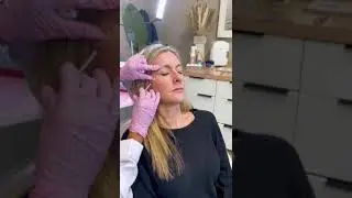 Botox Dosage vs Duration