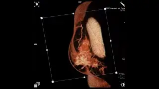 nu:view Breast CT: Small & dense breast