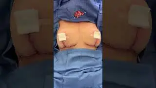 A Breast Reduction & Lift Surgery! Remarkable Results! #breast #lift