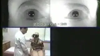Casani Treatment 3C