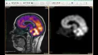 FusionSync Tutorial - Part 02: MR-SPECT Epilepsy