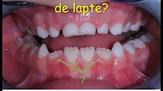 FAB Dent - Dinti de lapte (baby teeth)