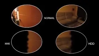HEMIANOPSIA: REHABILITACION CON LOS PRISMAS EN BANDA DE PALOMAR