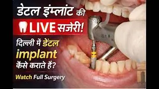 Dental Implant Complete Procedure | Best Teeth Implant Hospital in India | Top Implantologist Delhi
