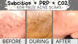 Subcision + PRP + Co2 Laser for True Acne Scars