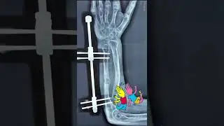 DISTAL RADIUS OSTEOTOMY AND ULNAR LENGTHENING USING JESS FOR CLUB HAND