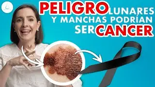 🔴 LUNAR &iquest;Es un Lunar MALIGNO? &iquest;Como saberlo? @drapilarochoa - Dermatologa