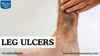 LEG ULCERS  -Homeopathy Treatment Drkukreja kalani online consultation 8291492566
