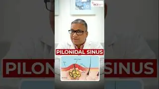 Tailbone के पास Lump? जानिए Pilonidal Sinus के Sign #tailbone #pilonidal #sinusrelief