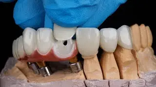 Dental Tourism: Turkey's Secret to Affordable and Top-Notch Dental Care - What Makes it the Lea