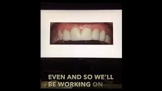 Building A Wide Smile w/ Bioclear Uveneers | Part 9