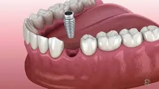 What Is a Single Tooth Implant? | Permanent Tooth Replacement in Sidcup