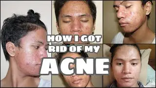 HOW I GOT RID OF MY SEVERE ACNE | MY ACNE JOURNEY | DYNEL LOVE