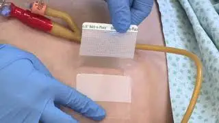 Mise en place - Fixation et patch pour sonde de Foley