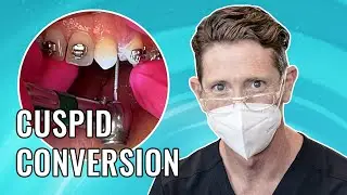 Cuspid Conversion