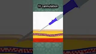 💉 INTRAVENOUS (IV) CANNULATION ANIMATION | IV ACCESS, INJECTION