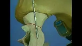 posterior screw fixation of the sacroiliac joint
