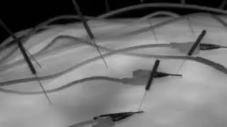 Acupuncture in Infrared: A LWIR and MWIR Comparison
