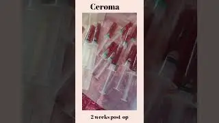 Ceroma drainage.  2 weeks post-op. Aftercare is the key to a successful recovery.