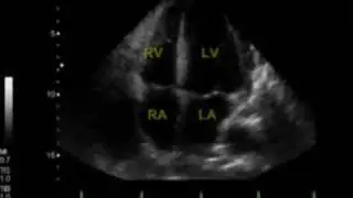 4E. Normal Echo Pattern ~ Compare with 4A-D (WINFOCUS, CC ECHO Course, by Gabriele Via)