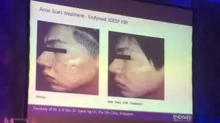 Optimal treatment of acne scars in asian and dark skin types