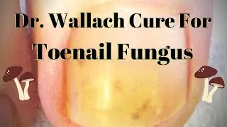 Dr  Wallach on Toenail Fungus