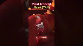 Have you ever wondered how an ARTIFICIAL HEART is installed? #heartsurgerysurvivor #shots #health