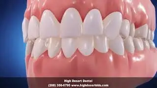 Invisalign Dentist Boise ID