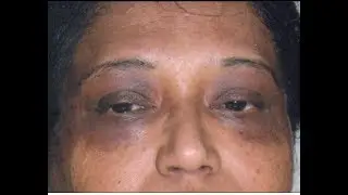 Hii ndo njia rahisi ya kuondoa weusi chini ya macho,pua na kwenye paji la uso