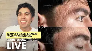 Dr. Qazi discusses Temple Scars, Mental Health, Subcision | Dr. Qazi Unsponsored Live | 5.14.2025