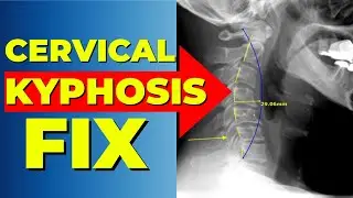 Cervical Kyphosis: The Hidden Car Crash Injury Doctors Miss (Fix It Without Surgery!)