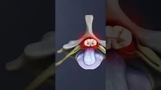 C6 Spinal Nerve & C6-C7 Compression: Sensory Changes and Spinal Cord Impact Explained