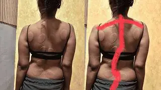 Scoliosis Treatment  Chiropractic Adjustment | Dr Jeetu Mishra